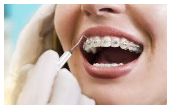 Dental Braces